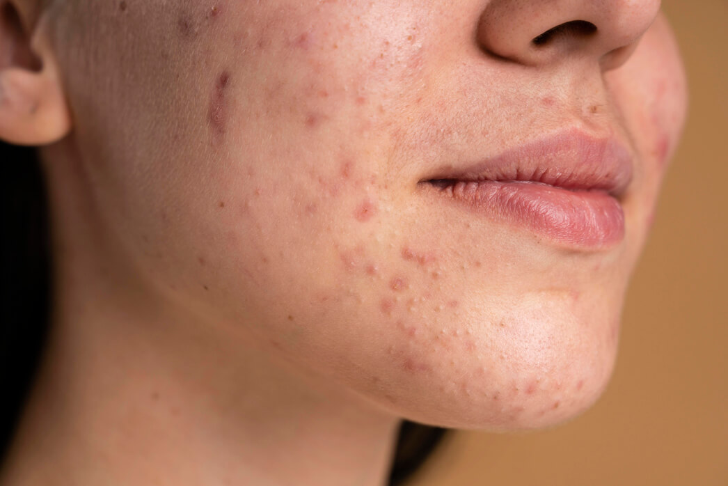avanguardia poliambulatorio_dermatologia_acne