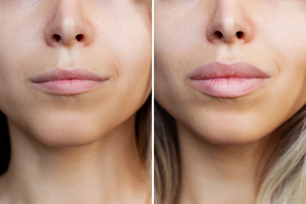 avanguardia poliambulatorio_estetica del volto_filler labbra